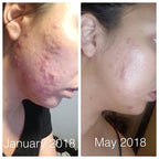 Super Acne Fighter / Trattamento biologico per l'acne / Acne