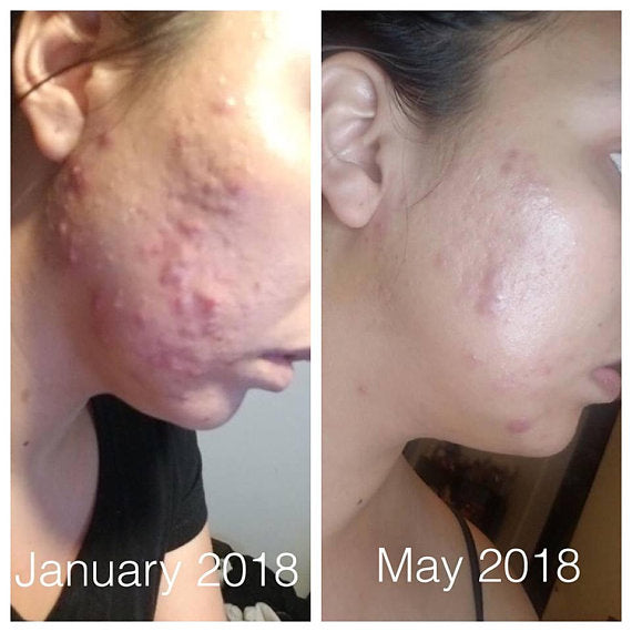 Super Acne Fighter / Trattamento biologico per l'acne / Acne