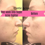 Super Acne Fighter / Trattamento biologico per l'acne / Acne