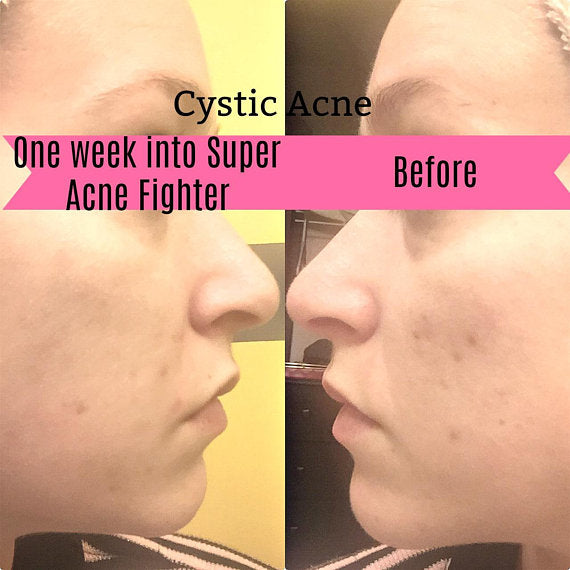 Super Acne Fighter / Trattamento biologico per l'acne / Acne